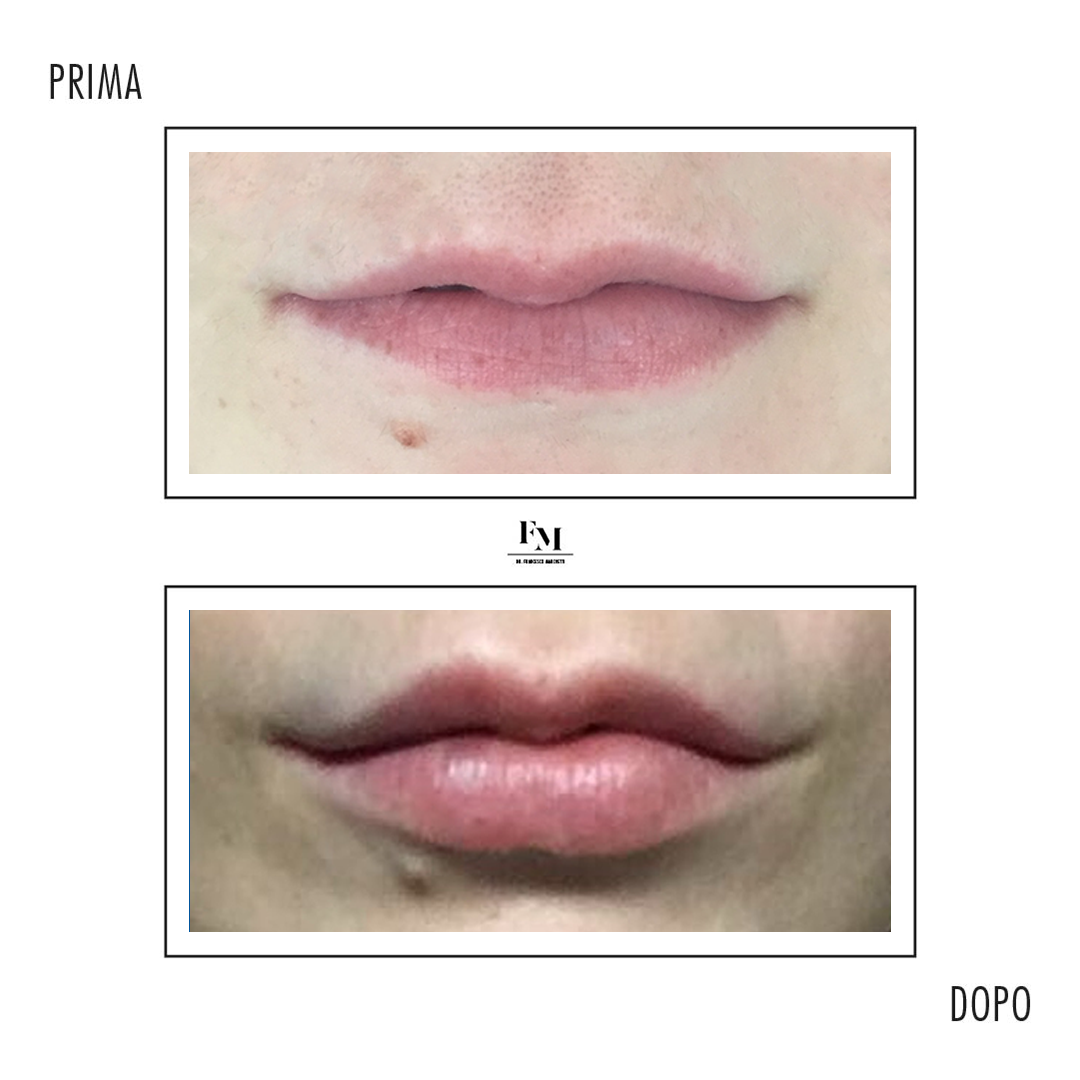 Rimodellamento labbra 2 - Dr. Francesco Marchetti